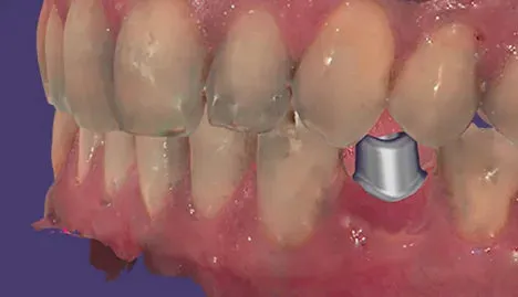 exocad - Chairside CAD Implant Module