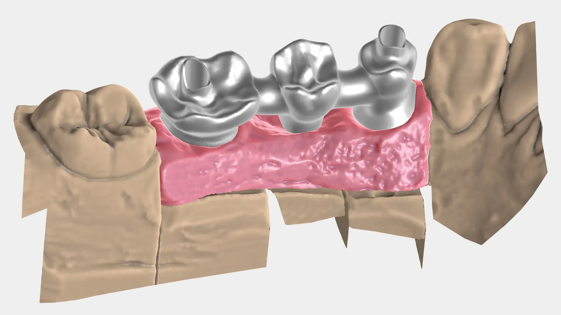 exocad - Chairside CAD Implant Module