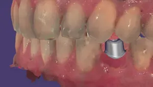 exocad - Chairside CAD Implant Module