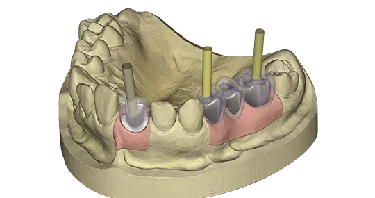exocad - Chairside CAD Implant Module